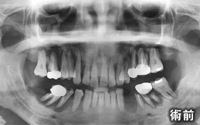 傳統植牙-術前圖