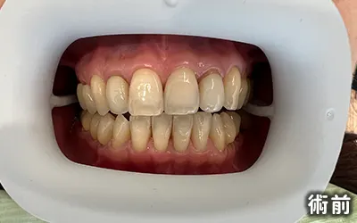 牙齒冷光美白-術前圖